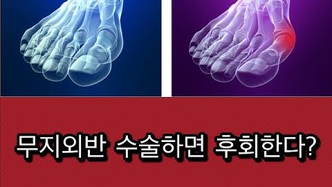 무지외반 진정한 교정방법.수술하면 절대안되는 이유