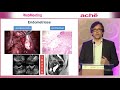 AULA 1   DIAGNÓSTICO E TRATAMENTO DE ENDOMETRIOSE