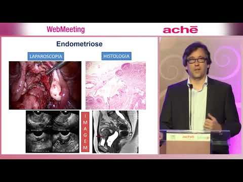 AULA 1   DIAGNÓSTICO E TRATAMENTO DE ENDOMETRIOSE