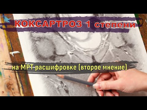 КОКСАРТРОЗ 1 степени и ЖИДКОСТЬ в тазобедренном суставе на РАСШИФРОВКЕ МРТ второе мнение
