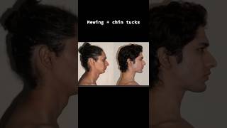 How to fix forward head posture