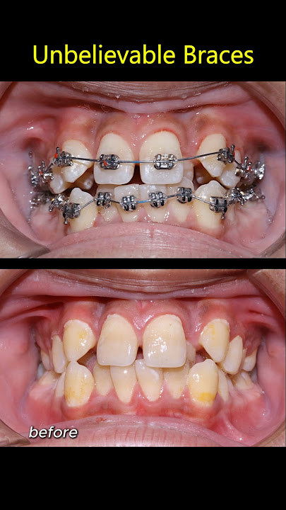 Braces unbelievable. Fix super crooked teeth. Best dentist #orthodontist #braces