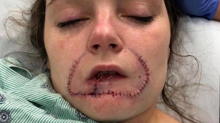 Woman Gets Surgery to Restore Lip Her Ex-Boyfriend Bit Off - DayDayNews