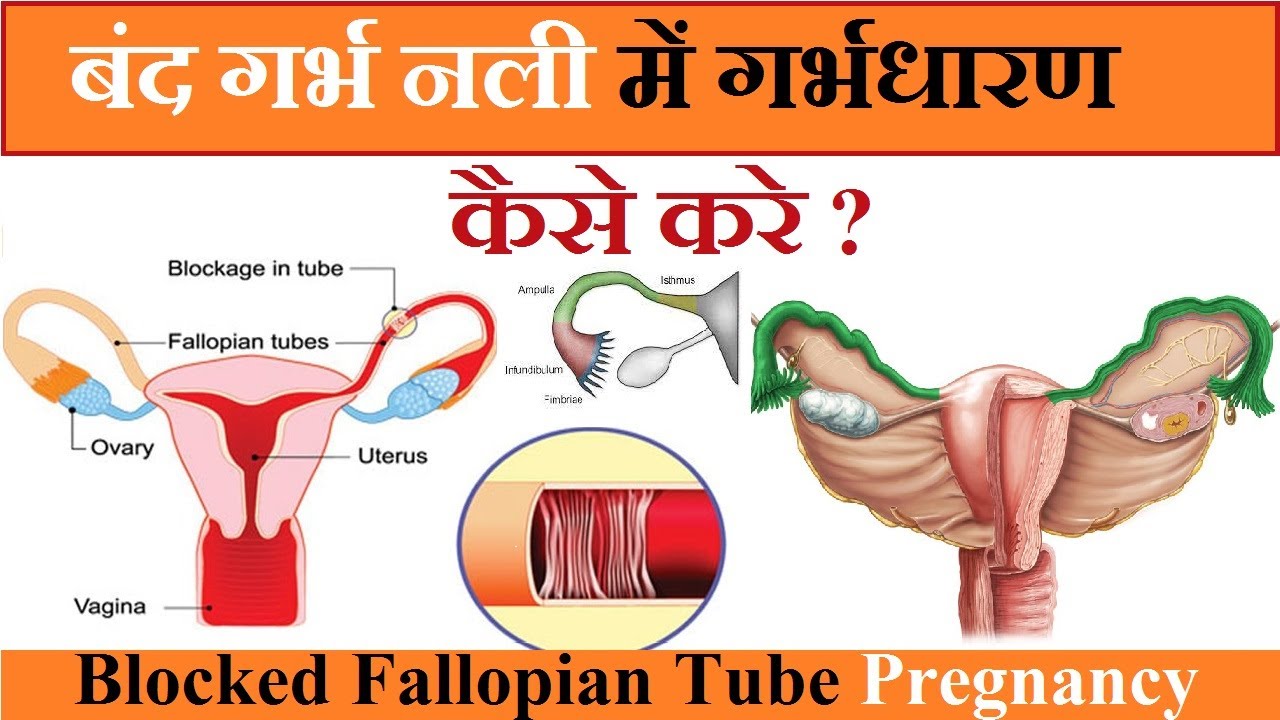 बंद गर्भ नाली में गर्भधारण कैसे करे? Block Fallopian Tube Pregnancy picture