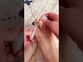 Doctor-Style Ingrown Toenail CorrectionPerfect Nail Alignment