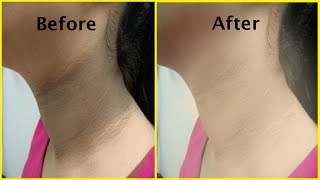 काली गर्दन को गोरा करने करने के 4 घरेलू नुस्खे | How to Get Rid of Dark Neck in 20 Minutes