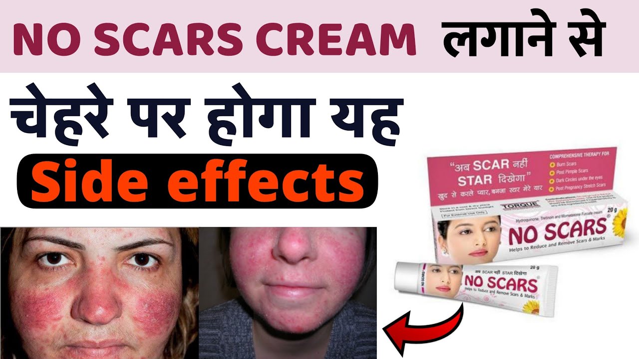 No scars cream side effects No Scars cream ka use karne se yeh side