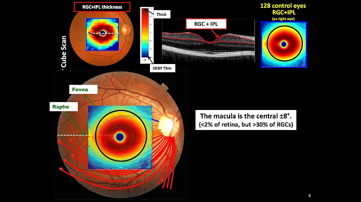 Donald HOOD. MACULAR DAMAGE IN GLAUCOMA