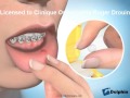Cire en orthodontie