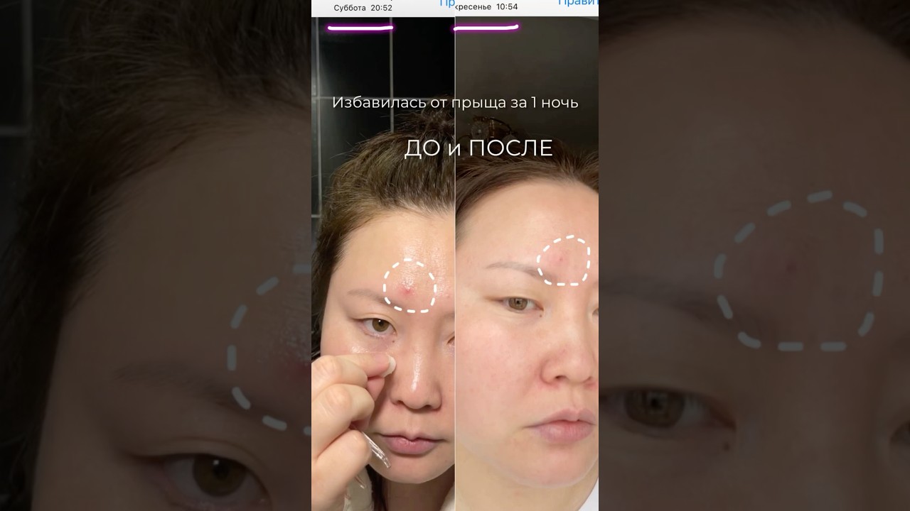 Я в восторге! Полное название COSRX The AHA 2 BHA 2 Blemish Treatment Serum 