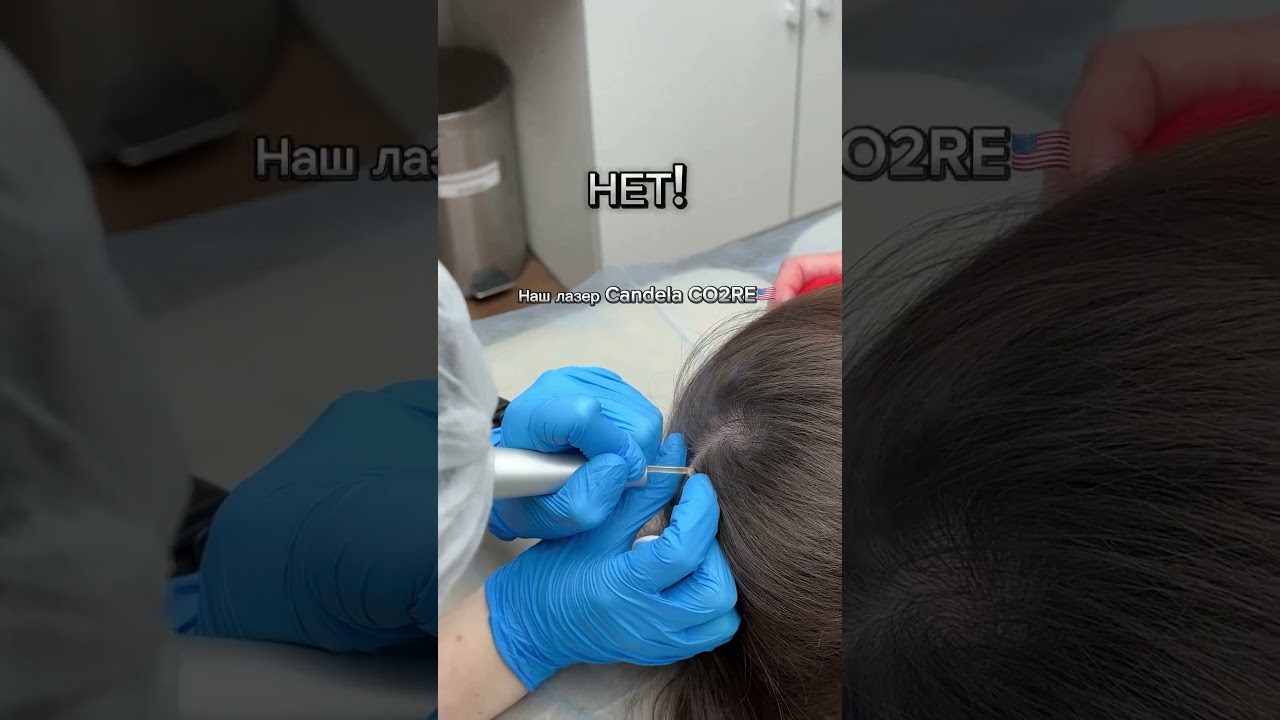 Удаление родинки на голове - будут ли расти волосы?