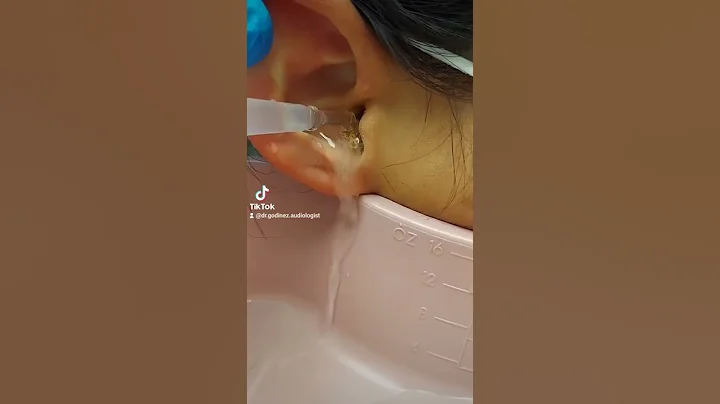 Earwax removal.... What did I just remove? Is it a large piece of wax or sometype of animal?