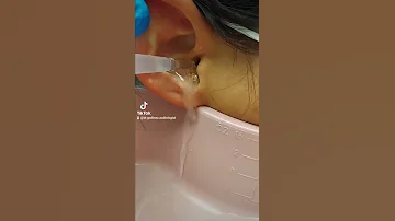 Earwax Removal What Did I Just Remove Is It A Large Piece Of Wax Or Sometype Of Animal 