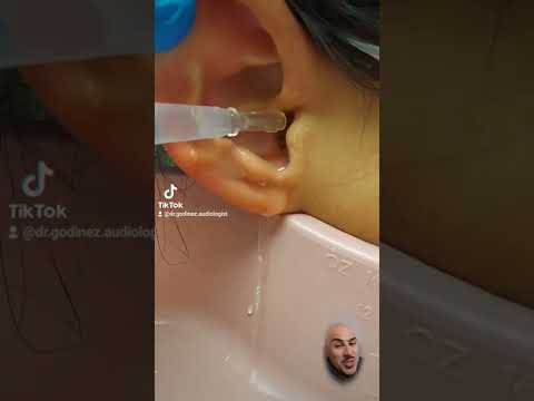 Earwax removal.... What did I just remove? Is it a large piece of wax or sometype of animal?