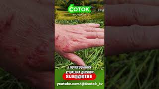 Опіки від борщівника Сосновського  Перші симптоми та лікування #shorts #shortsvideo #6соток