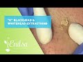 Blackhead & Whitehead Extractions on "K" Part 3