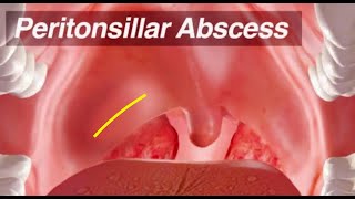 Peritonsillar Abscess - Identification and Treatment