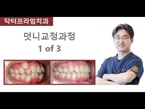 덧니교정과정  1of3