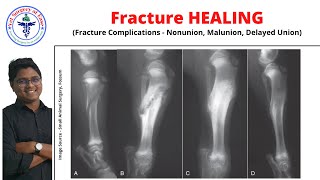 Fracture Healing | Lecture 10 | Orthopedics