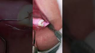 كسر الضرس بسبب تسوس الأسنان الشديد