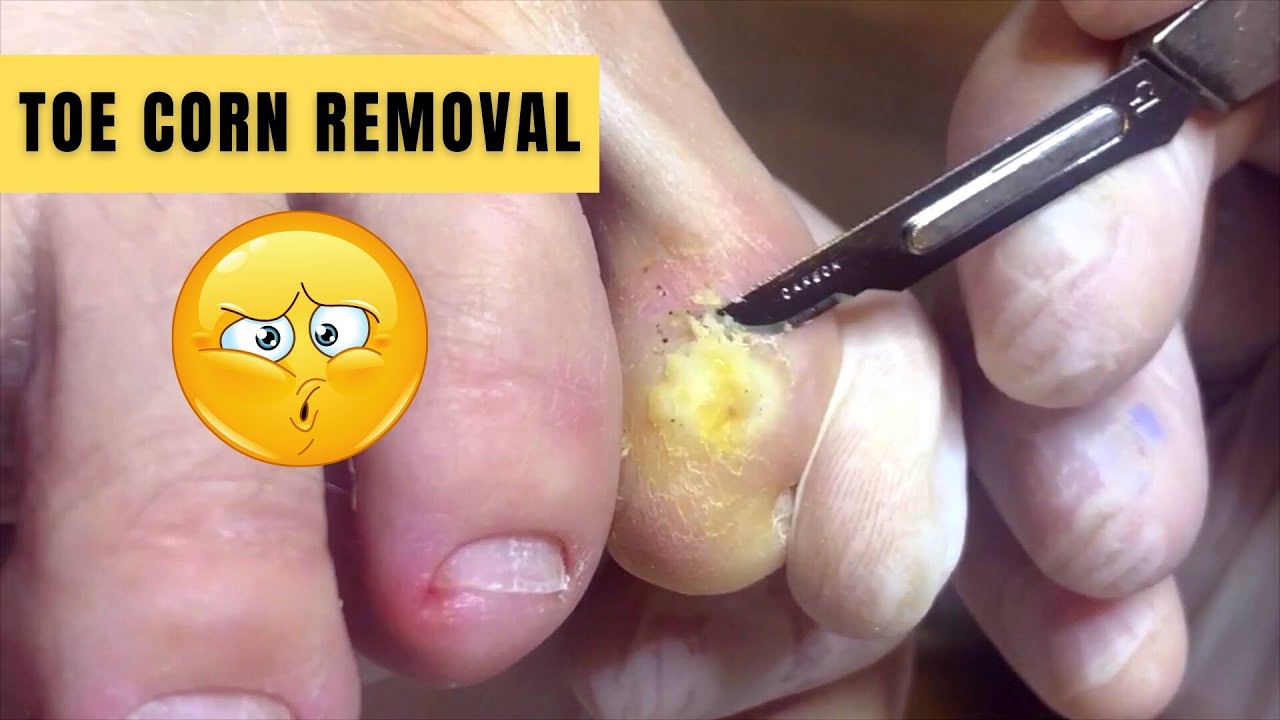 Soft and wet corn removal from toe|Αφαίρεση κάλου από το δάκτυλο - YouTube