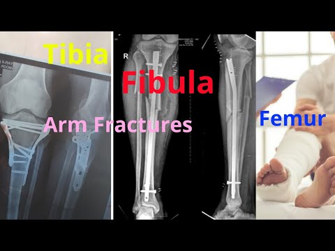 Tibia & Fibula Ke baadh thik hone ke sab se ache exercise. Tibia & Fibula Post Surgery Recovery Tips