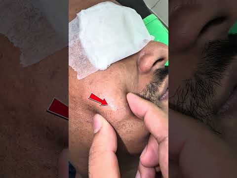 Large cyst punctum