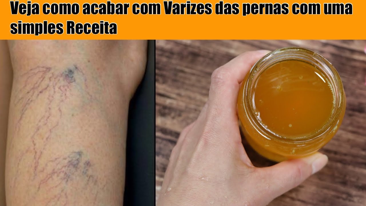 VEJA COMO SE LIVRAR DAS VARIZES NAS PERNAS COM UMA SIMPLES RECEITA