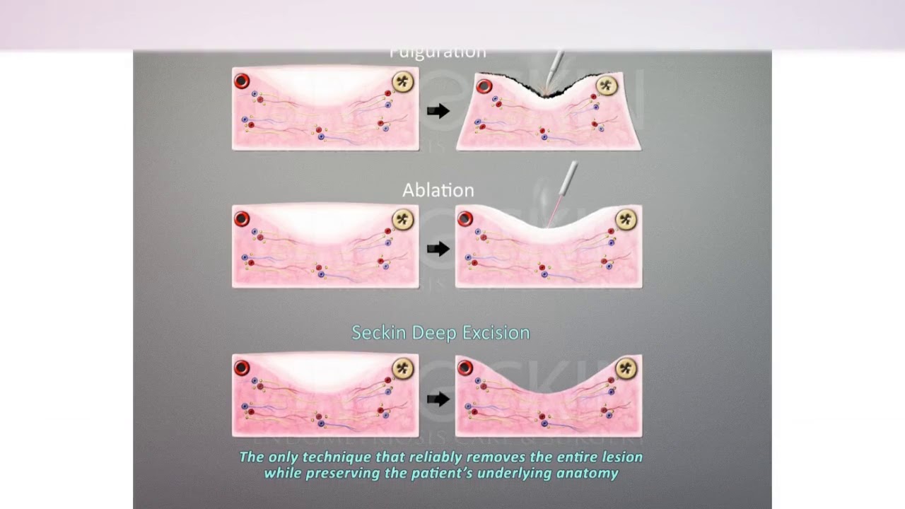seckin-endometriosis-treatment-surgery-center-youtube