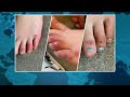Dermatologist explains potential dangers of ‘COVID toes’