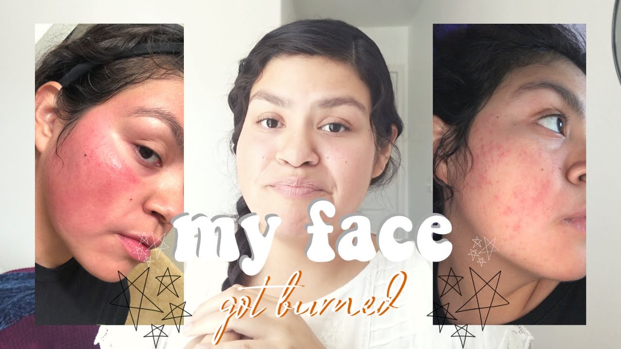 MY FACE GOT BURNED *skin update* YouTube