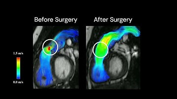 Pre/Post-operative visualization of blood flow from 4D Flow MRI