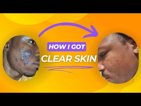 My 6 Years Acne Journey | How I Got Clear Skin - YouTube