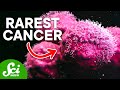 The Rarest Cancer in History (It's Also the Weirdest)