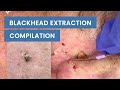 Extraction Satisfaction (Blackhead Removal) | CONTOUR DERMATOLOGY