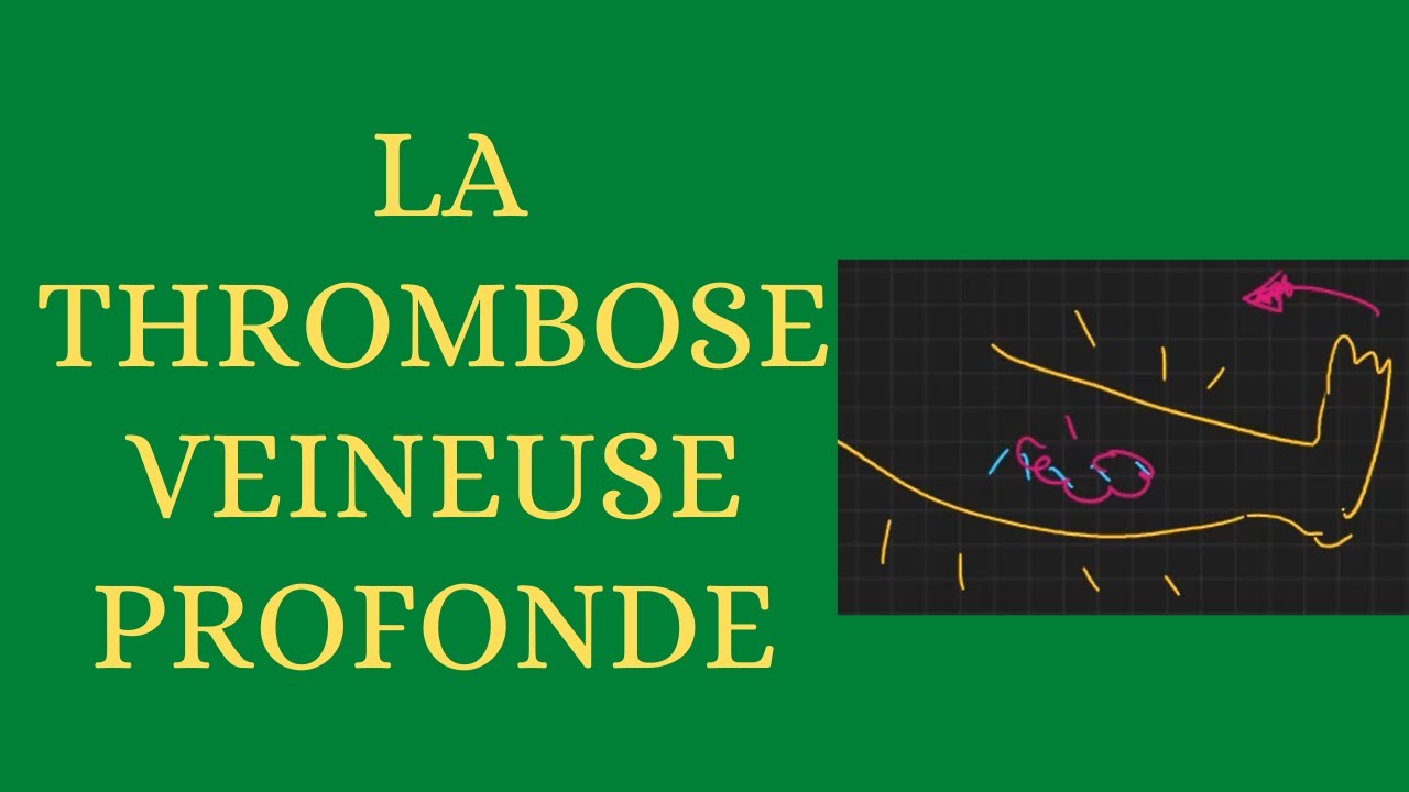 La thrombose veineuse profonde simplifiée
