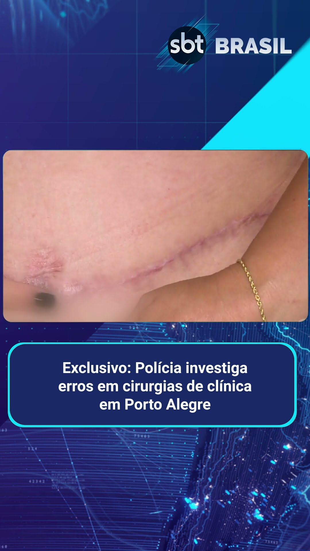 Exclusivo: Clínica é investigada por erros em cirurgias plásticas no RS | SBT Brasil (24/01/25)