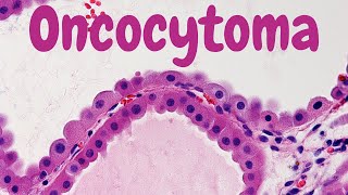 Renal Oncocytoma - Pathology Mini Tutorial