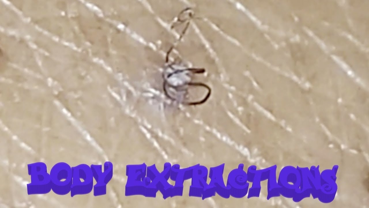 BODY EXTRACTIONS HAIR REMOVAL YouTube