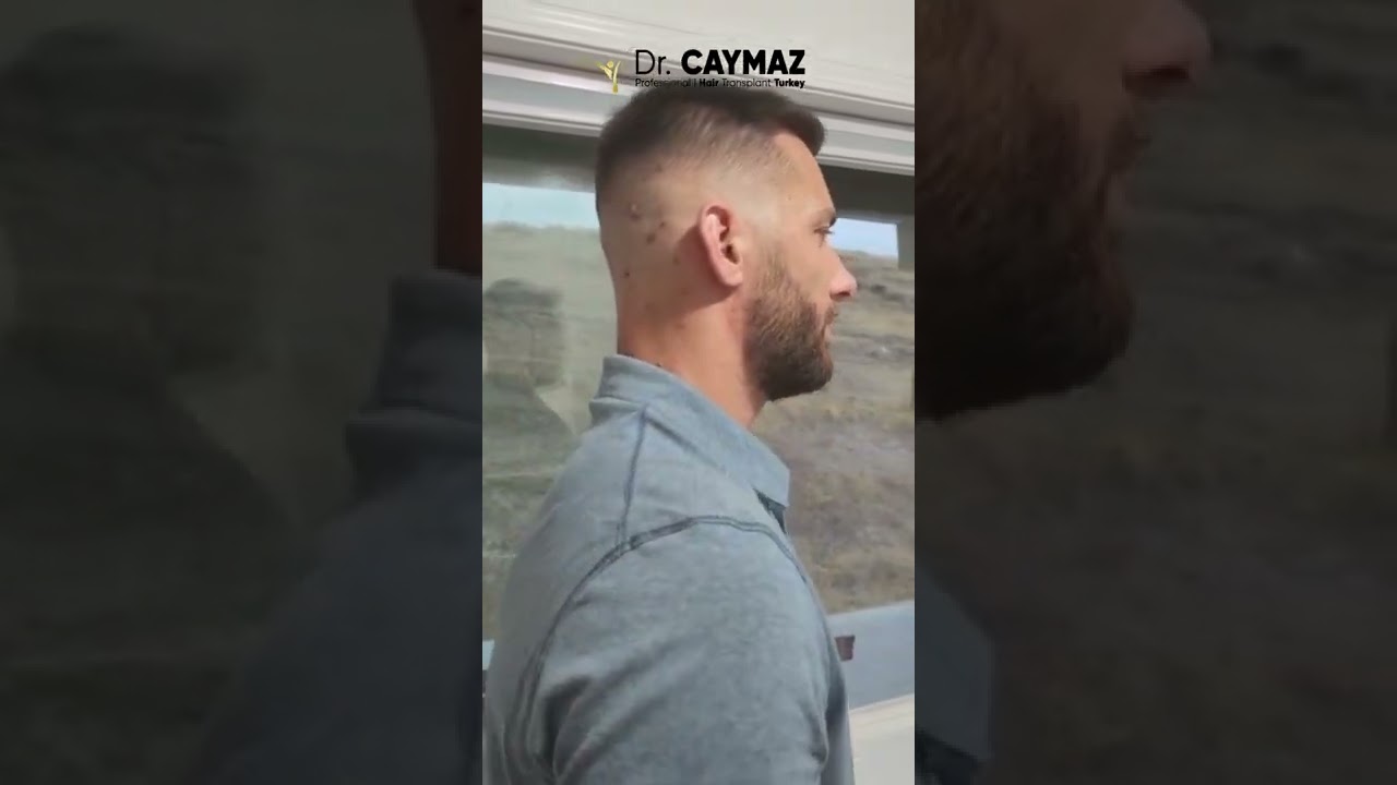 Mr Markus   7 Months   DHI   3000 Graft