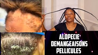 ALOPECIE,DEMANGEAISONS,PELLICULES TRAITEMENT.pousse des cheveux