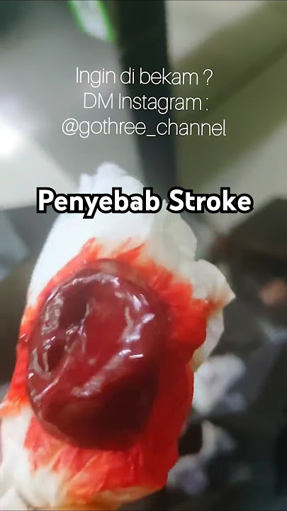ini nih penyebab stroke didalam tubuh #pengobatan #pengobatanalternatif #bekam #hijamah #terapi