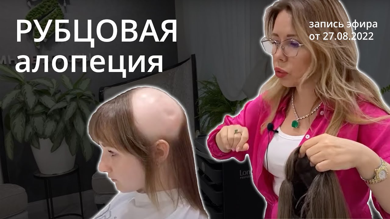 Рубцовая алопеция после лучевой терапии… - YouTube