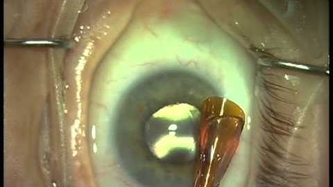 EndoSerter® Live Surgery - Dr. Brandon Ayers, Bala Cynwynd, PA (2012)