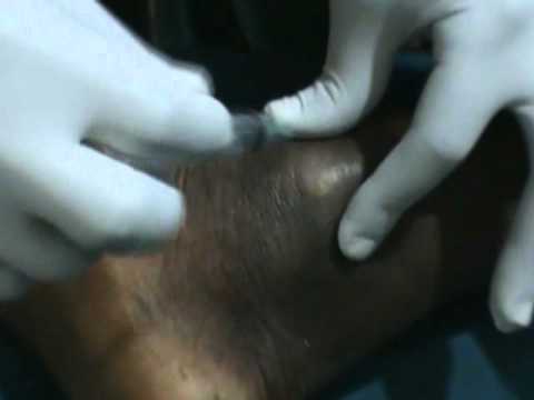 Buruli Ulcer Disease: Fine Needle Aspiration for Diagnosis of M. Ulcerans Infection