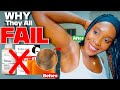 I Fixed My Dark Underarms| Why They All Fail for Dark Underarms, Glycolic Acid, Kojic Acid....