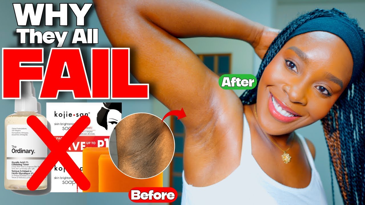I Fixed My Dark Underarms| Why They All Fail for Dark Underarms, Glycolic Acid, Kojic Acid....