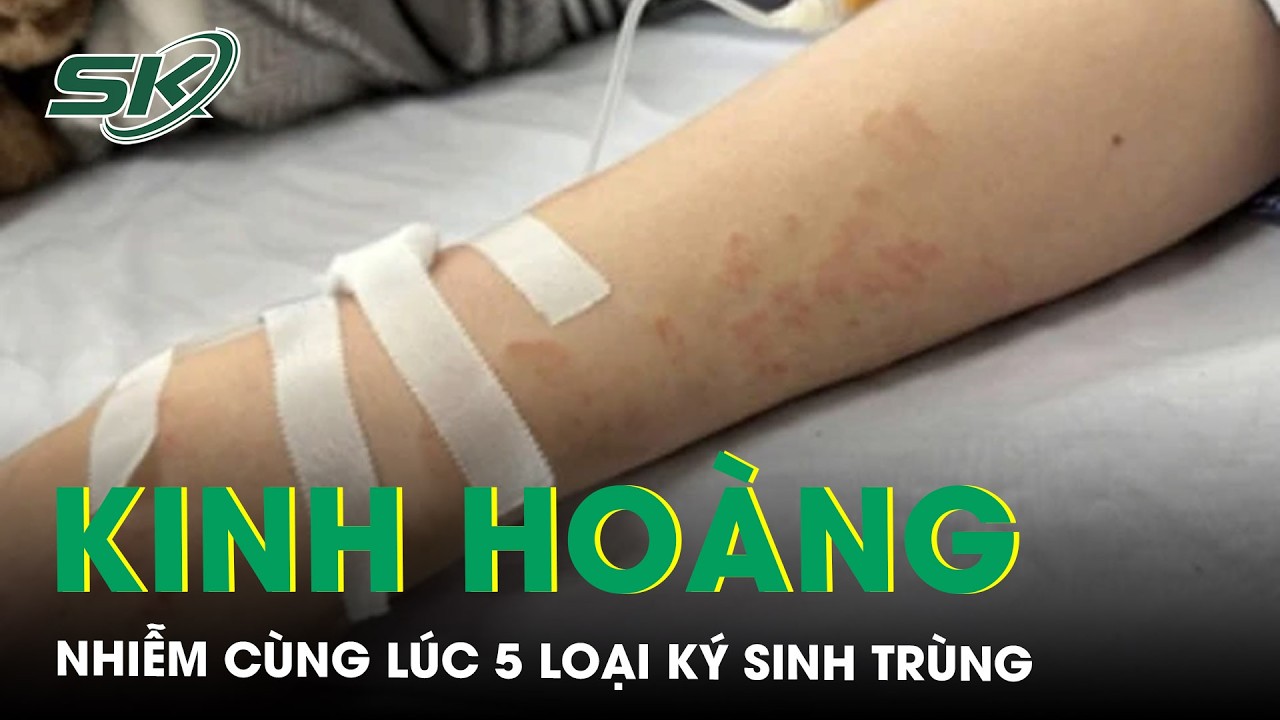 Người phụ nữ nhiễm cùng lúc 5 loại ký sinh trùng | SKĐS