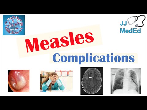 Measles Complications (Immunosuppression, Encephalitis, SSPE, etc), Diagnosis, Treatment, Prevention