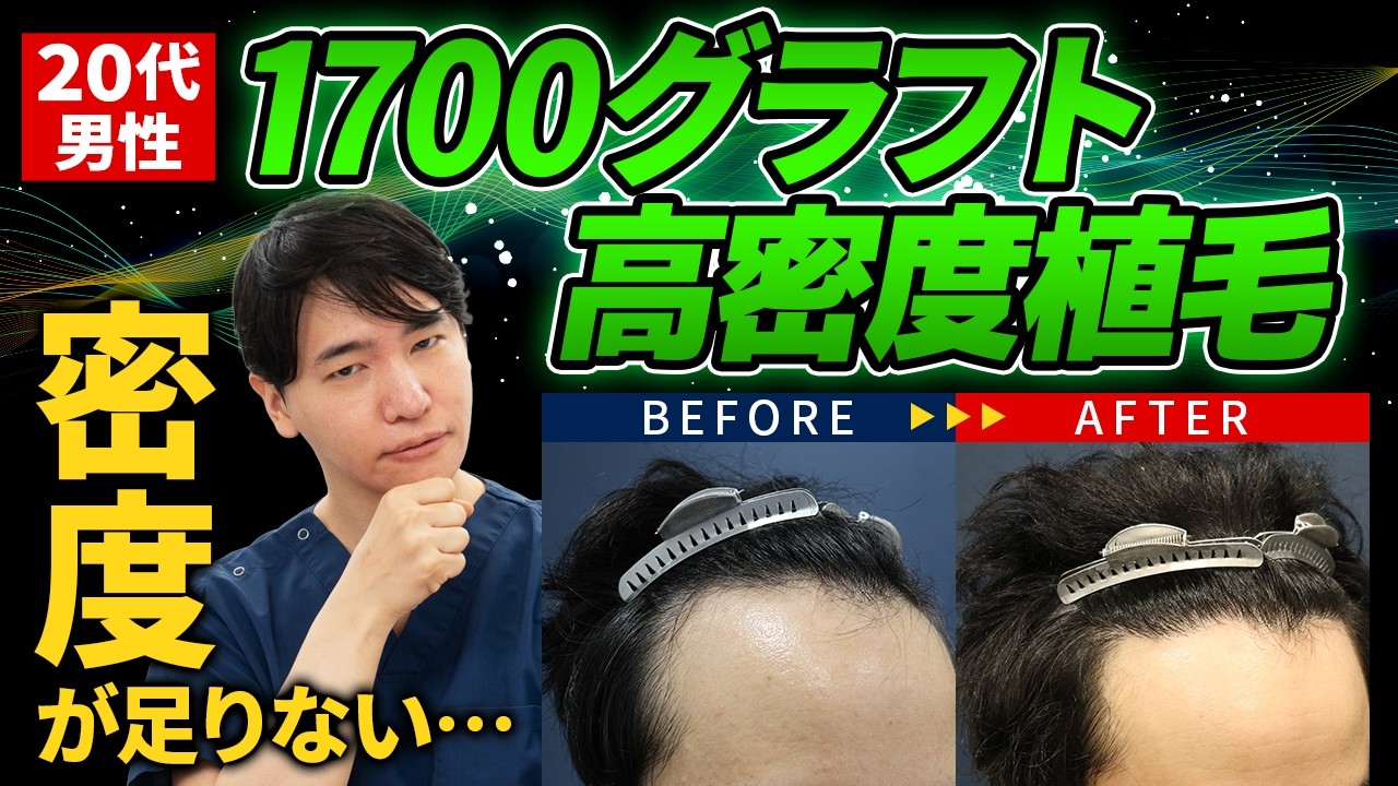 植毛症例 025】20代 男性 生え際 1700グラフト - 【公式】自毛植毛専門